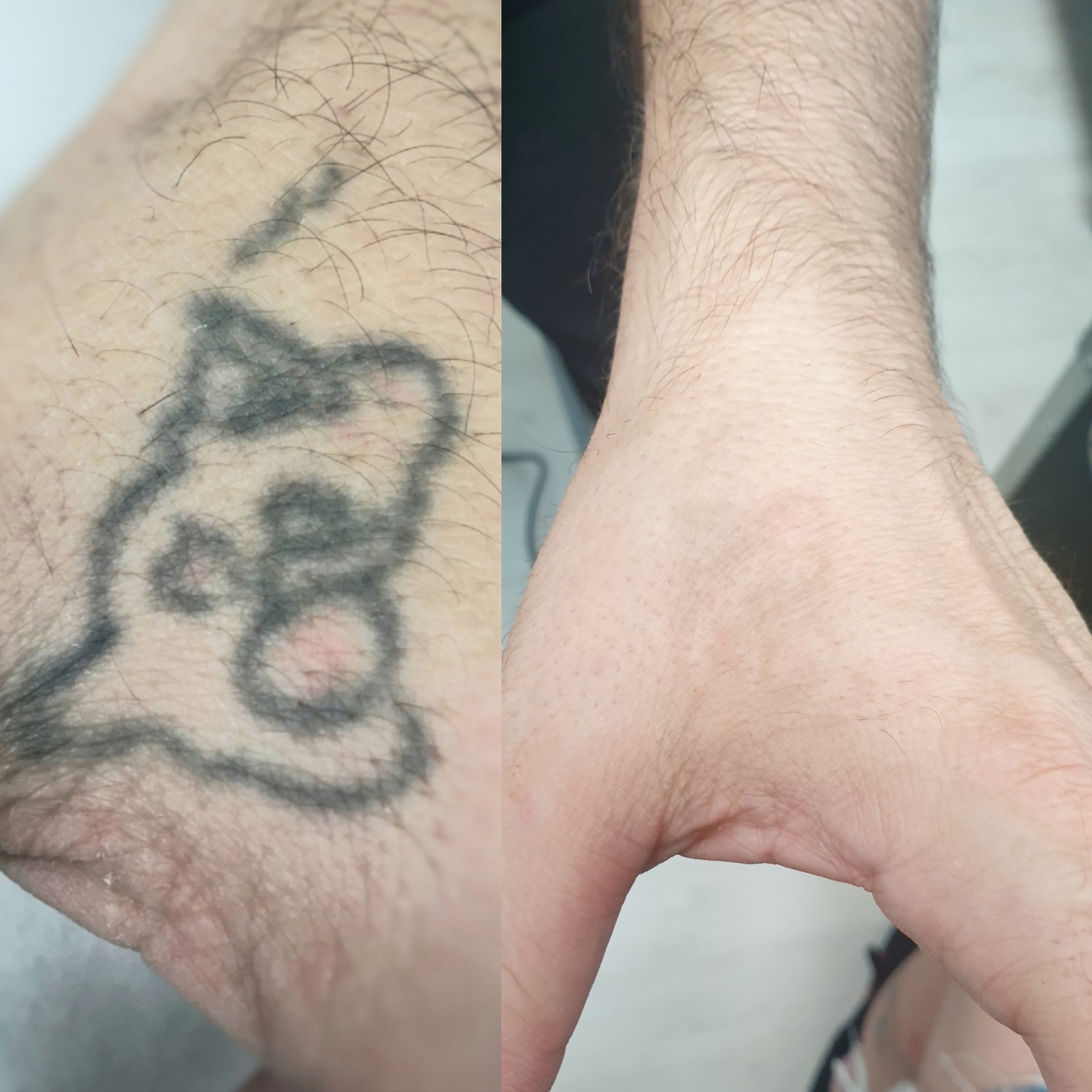 Eliminar tatuajes en Barcelona con láser - Pro-Arts